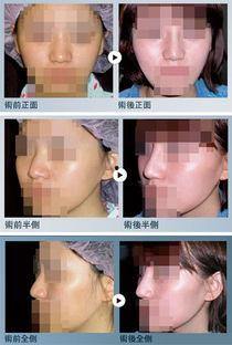 隆鼻3D视频