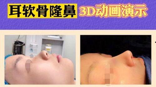 隆鼻3D视频